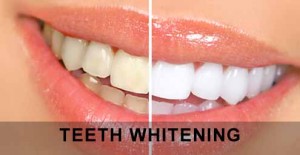 teeth whitening