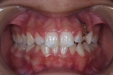 Tooth Bonding & Repair | Dentist Staten Island NY