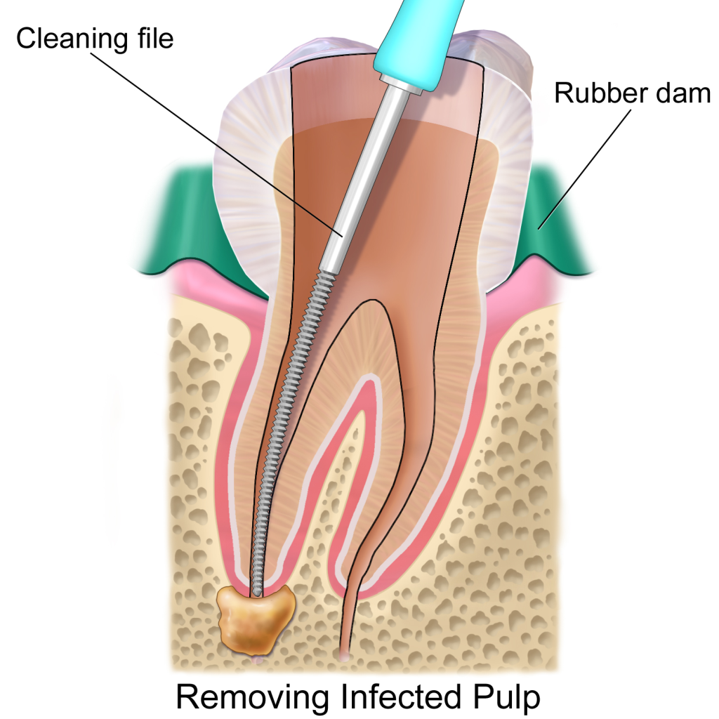 Root Canal Treatment What to Expect