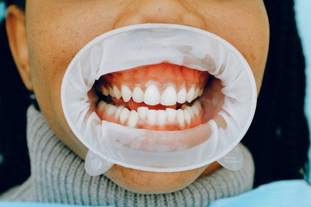 Teeth Whitening Options-Professional vs Over-the-Counter